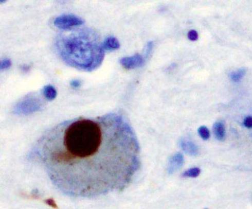 New blood test may help diagnose Parkinson’s earlier