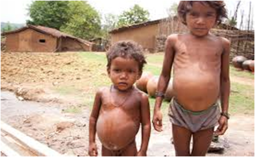 Child Malnutrition Still Rampant in Jharkhand