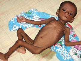 Malnourished children in Jharkhand get hope of life scheme-Jeevan Asha