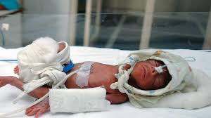 India on top of the world in recording preterm births of babies